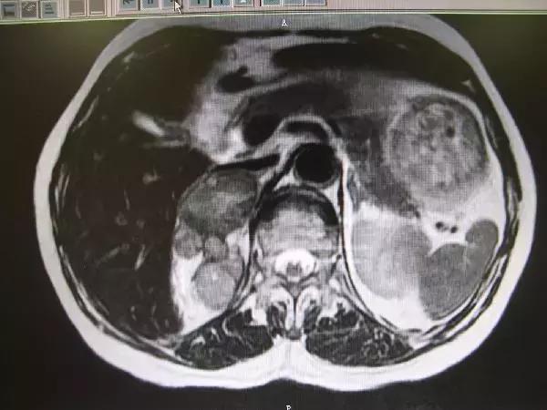 肾上腺瘤需要做增强ct吗,体检查出肾上腺瘤怎么办
