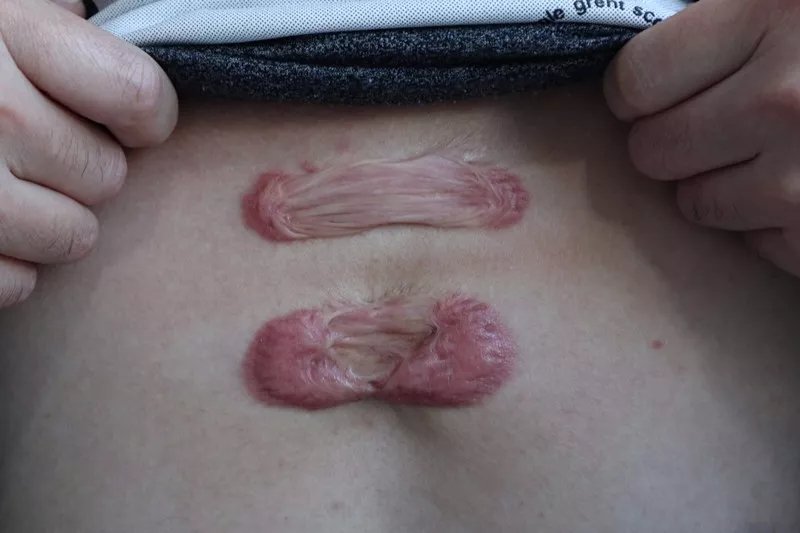 夏天疤痕治疗怎么做,夏季疤痕如何护理