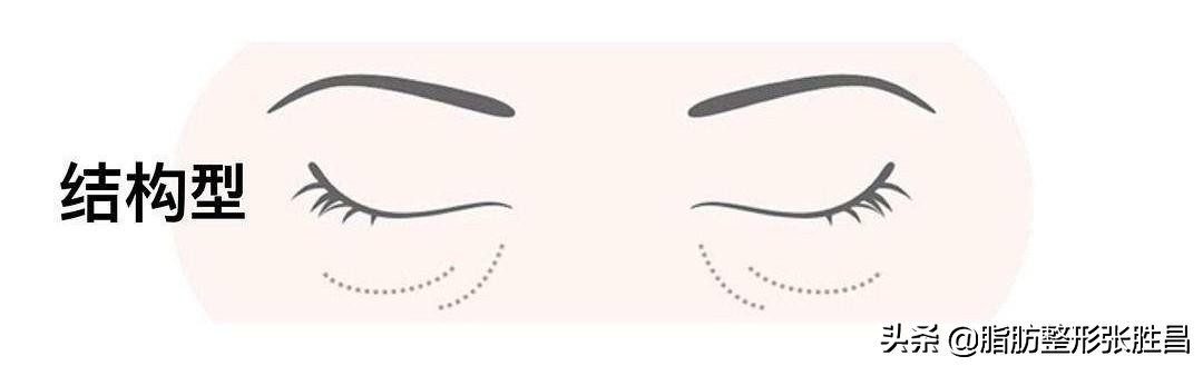 失眠黑眼圈重喝什么比较好,失眠黑眼圈怎么快速消除