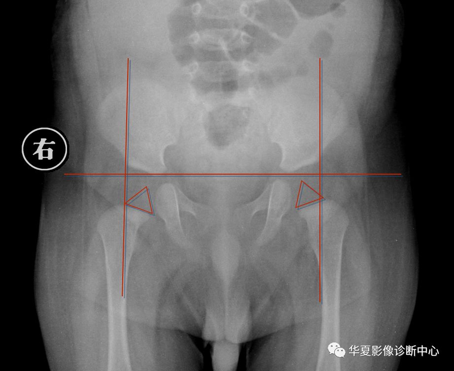 先天性髋关节脱位截骨术全过程,先天性髋关节脱位可以考驾驶证吗