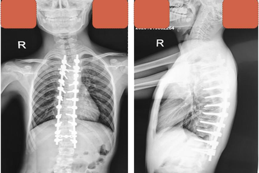 儿童脊髓空洞加脊柱侧弯,合并脊髓空洞的先天性脊柱侧弯