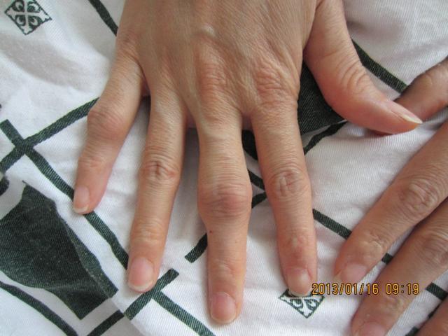 类风湿性关节炎最佳治疗,颞颌关节炎非甾体类抗炎药物