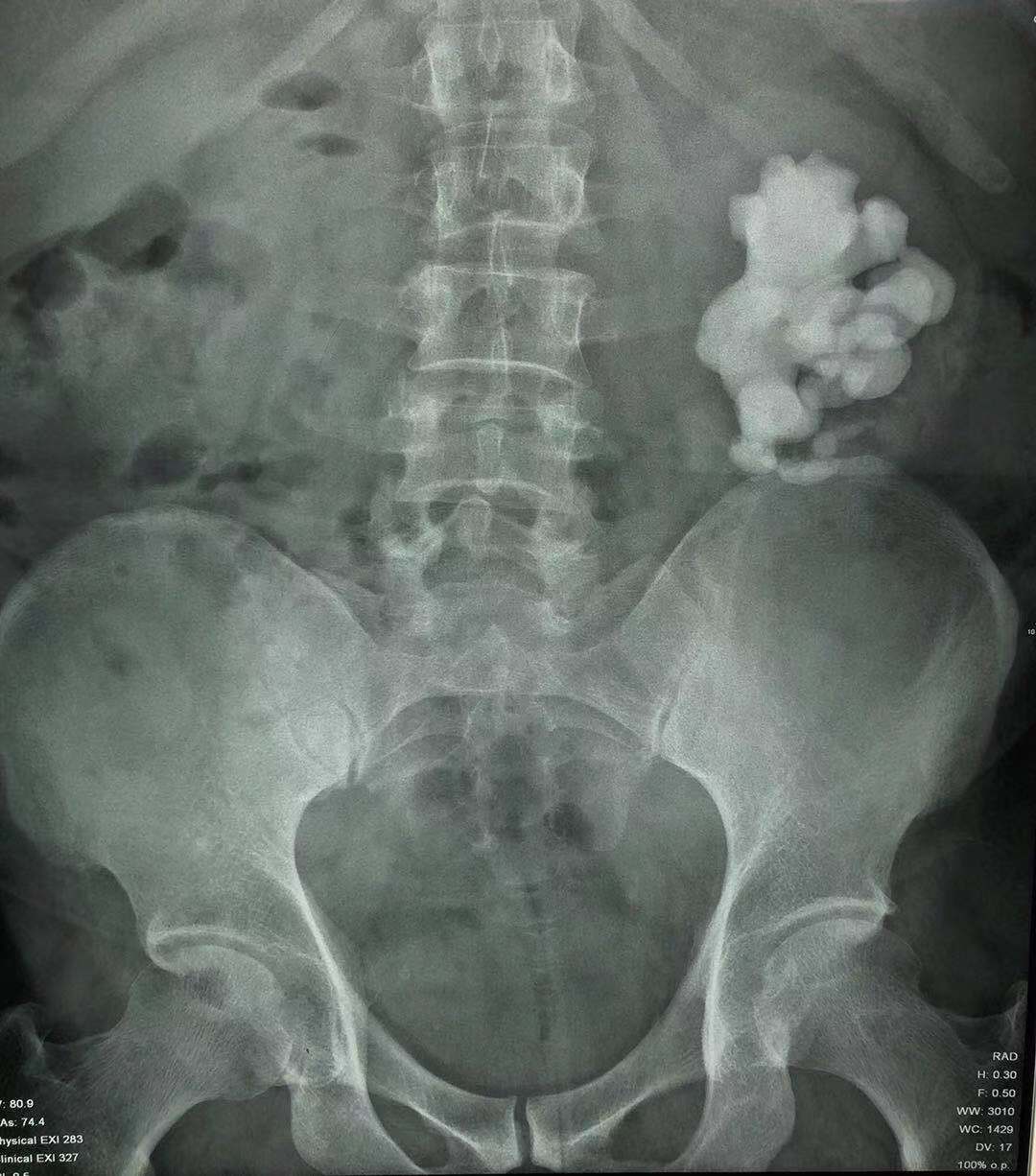 疯狂的石头碎石,疯狂的石头包世宏结石