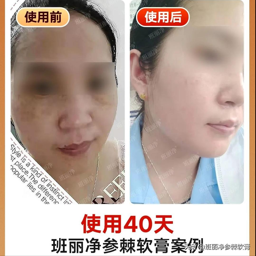 现在很多人都在祛斑靠谱吗,到底祛斑是真的还是假的