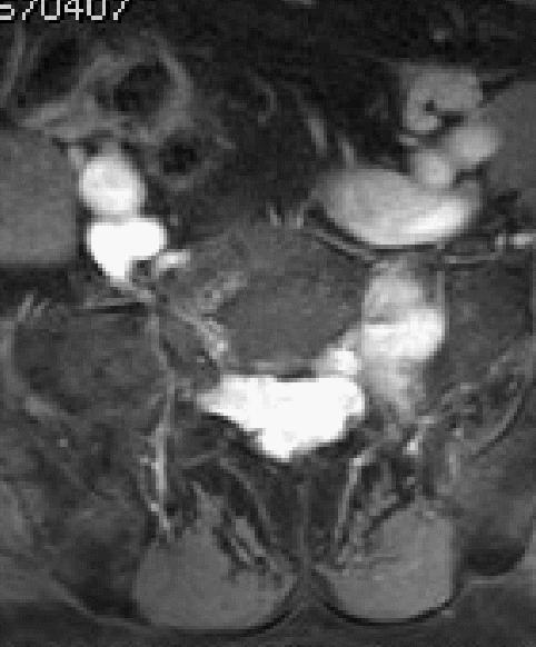 海绵状血管瘤在mri中的影像表现,骶骨处影像显示有血管瘤