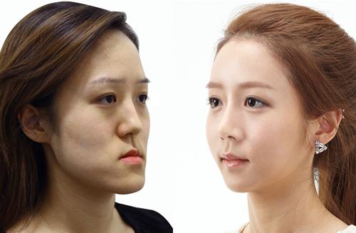 泰国最逆天的不是变性，而是堪比换头的整形