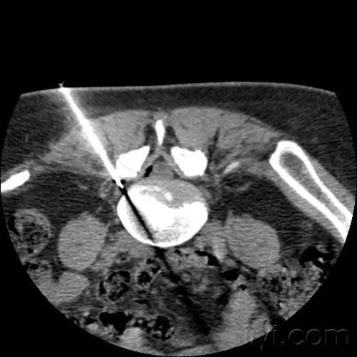 腰疼腿不疼会是椎间盘突出吗,椎间盘突出引起的腰痛怎么治