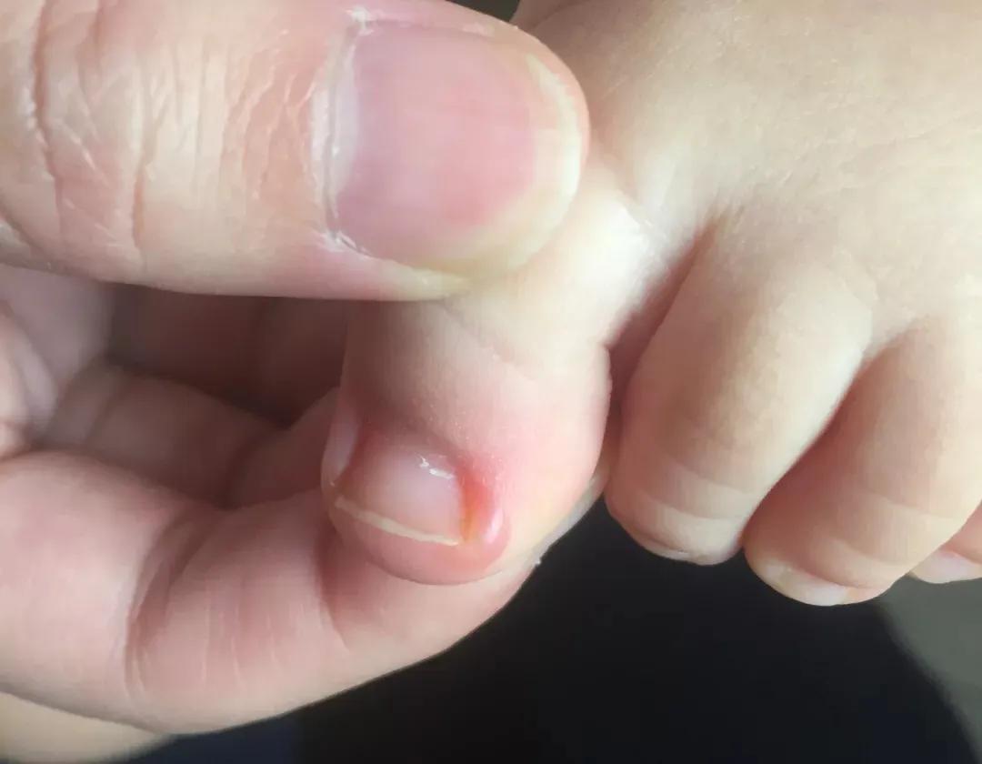 8个月未好的甲沟炎,小月龄甲沟炎症状