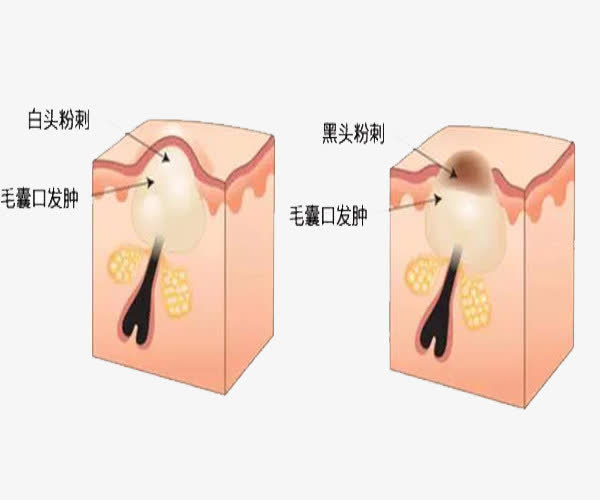 毛孔粗大怎么改善和调理,毛孔粗大到底怎么办学生