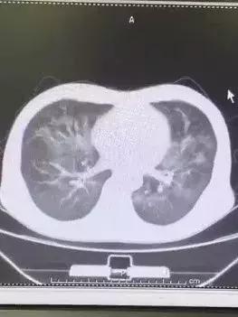 以为是肺炎，竟然得了艾滋病！HIV您真的了解吗？