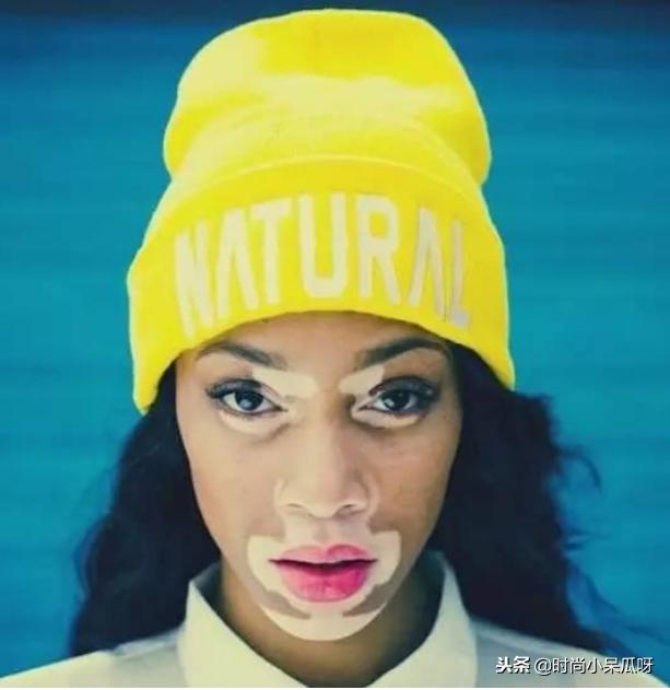 患白癜风的超模,有白癜风的国际名模