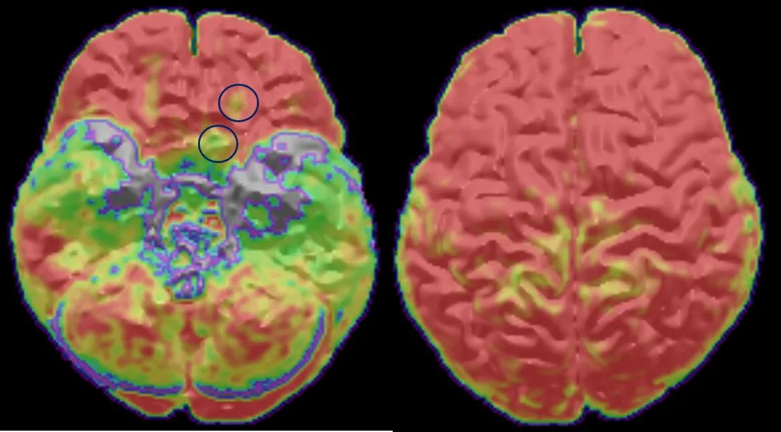 磁共振报告没有病灶，还能做癫痫外科手术吗？