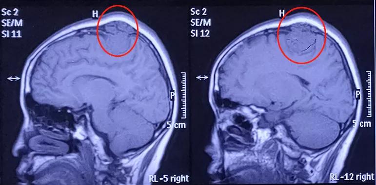 侵蚀颅骨的脑瘤是不是良性,脑膜瘤颅骨侵蚀后怎么办
