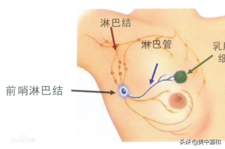 前哨淋巴结学问太多，知道这些你就“够用”了