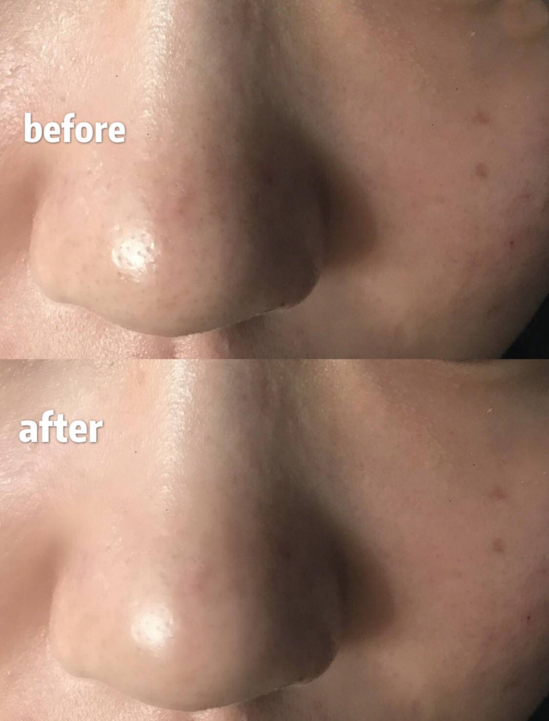 刷酸到底好不好,美容刷酸的副作用是什么