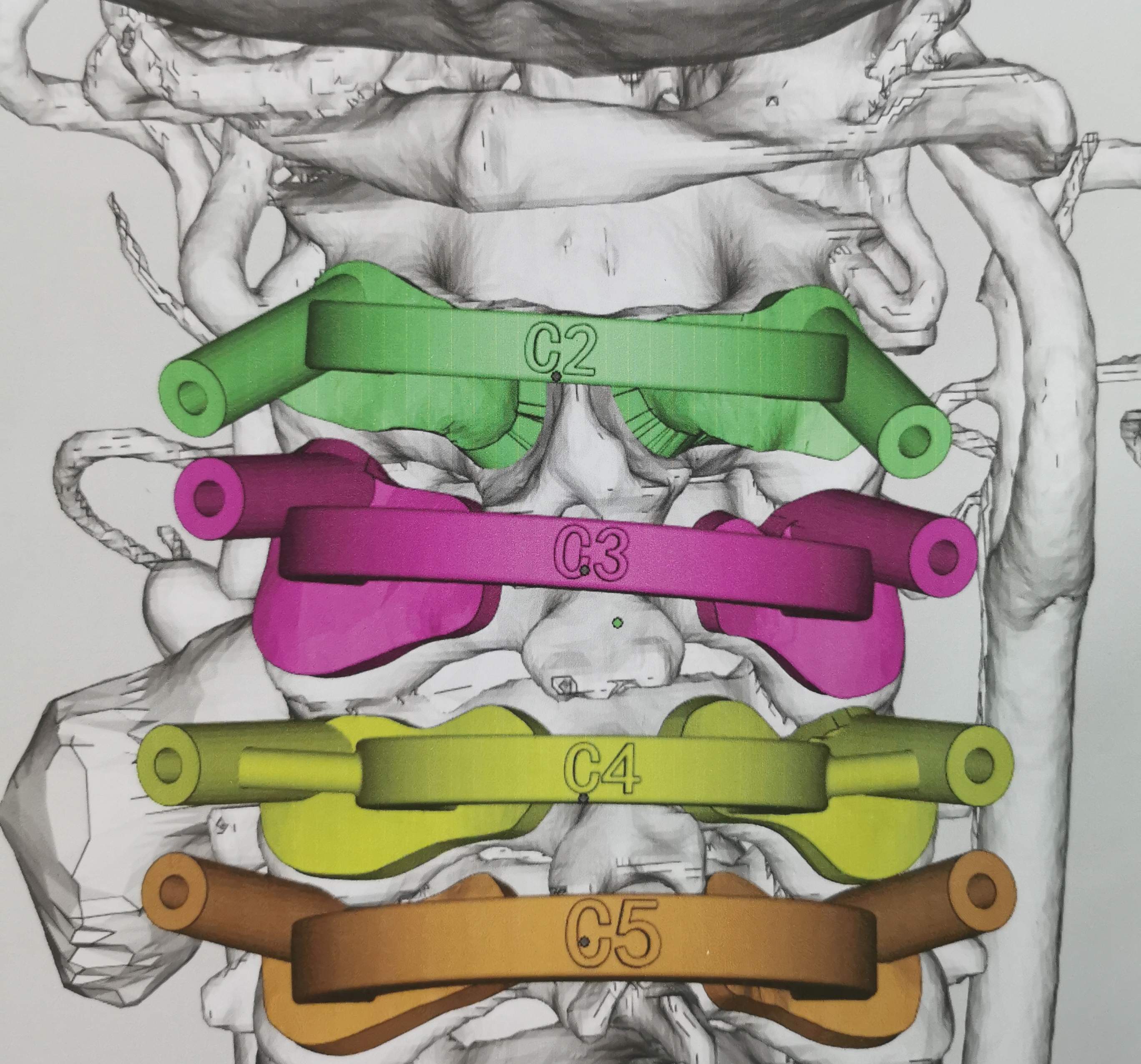 颈椎肿瘤切除术3d动漫演示,颈椎3d打印手术