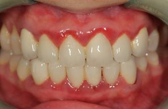 你的牙龈健康吗，5个方面自我检查