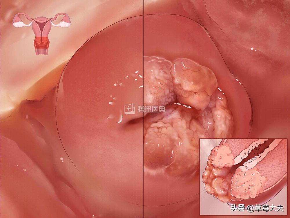 「人气案例」宫颈癌手术就得终生挂尿袋生活？草莓医院专家SayNo