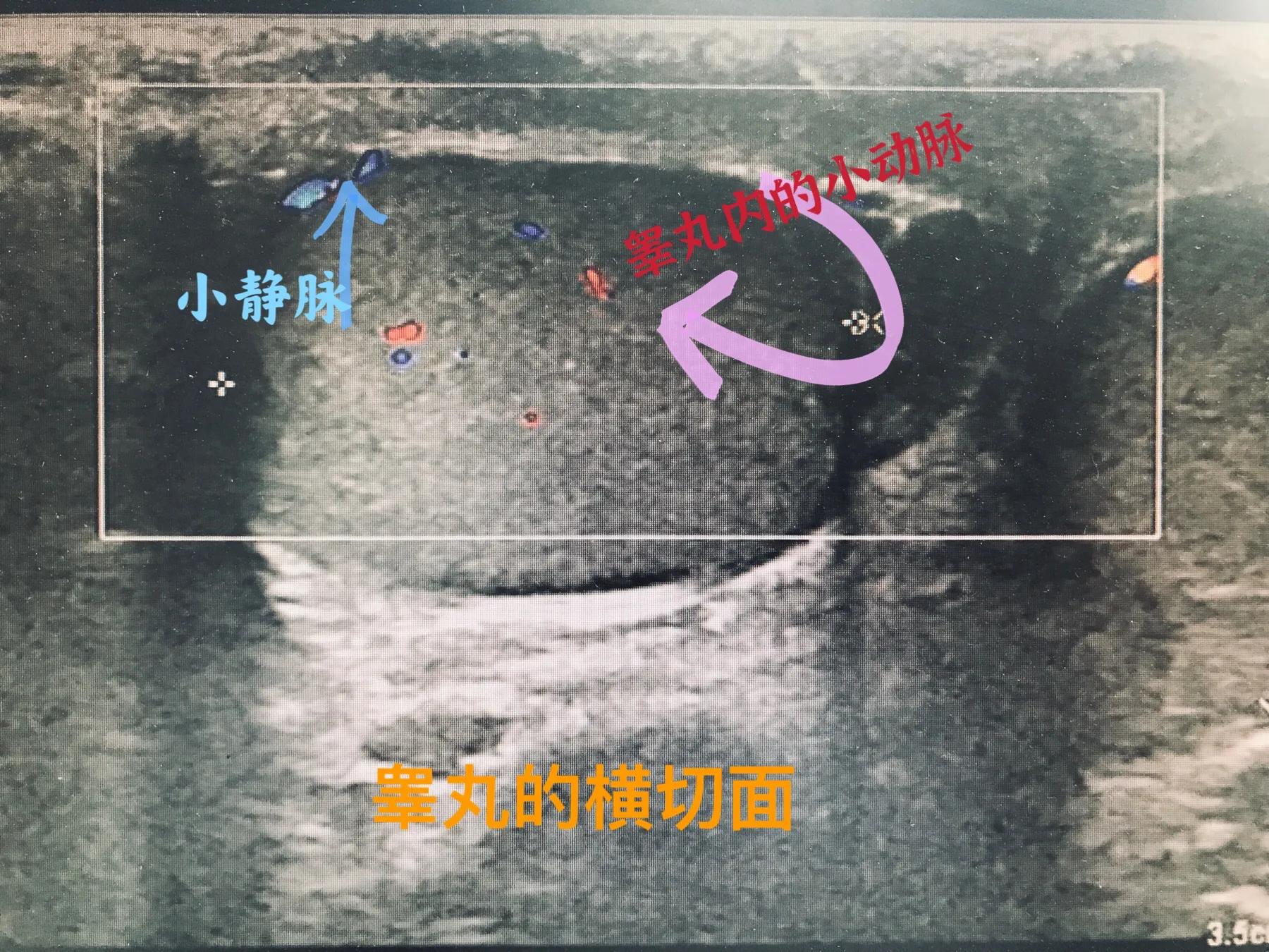 睾丸发生什么样的变化会影响生育,两侧睾丸都碎裂影响生育吗