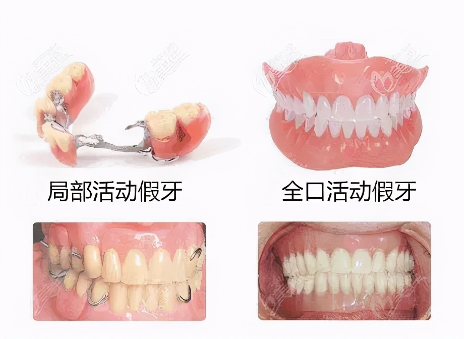 戴假牙的正确方法及注意事项,不懂保护牙齿将来会怎么样