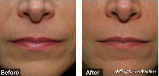 年龄大了想祛法令纹又不想动刀,泪沟法令纹不用动刀就能掩盖掉