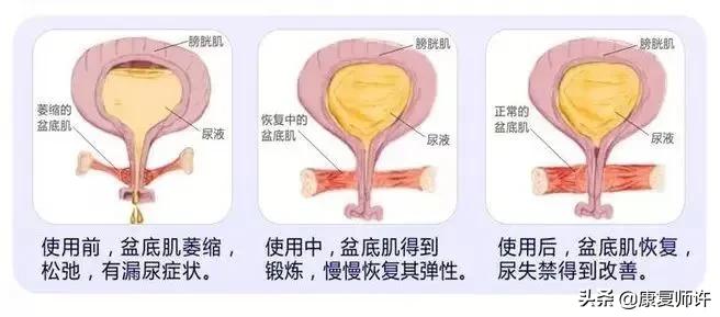 产后腹直肌分离恢复瘦肚子训练,产后腹直肌分离恢复的最佳方法