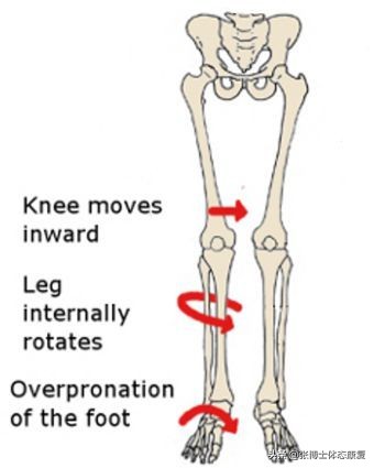 体态矫正小腿外翻,成年人x型腿加膝外翻怎么办