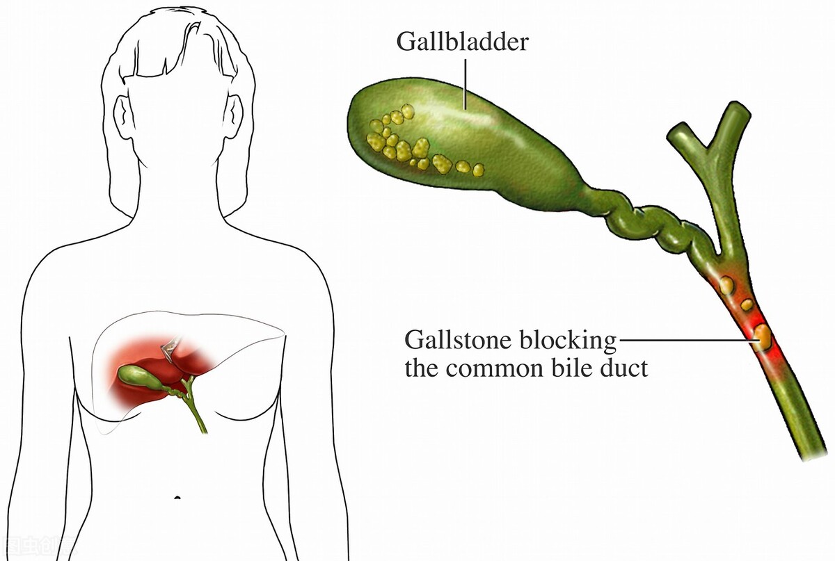 绝不是危言耸听！胆结石腹痛半年不治疗，差点和死神擦肩而过