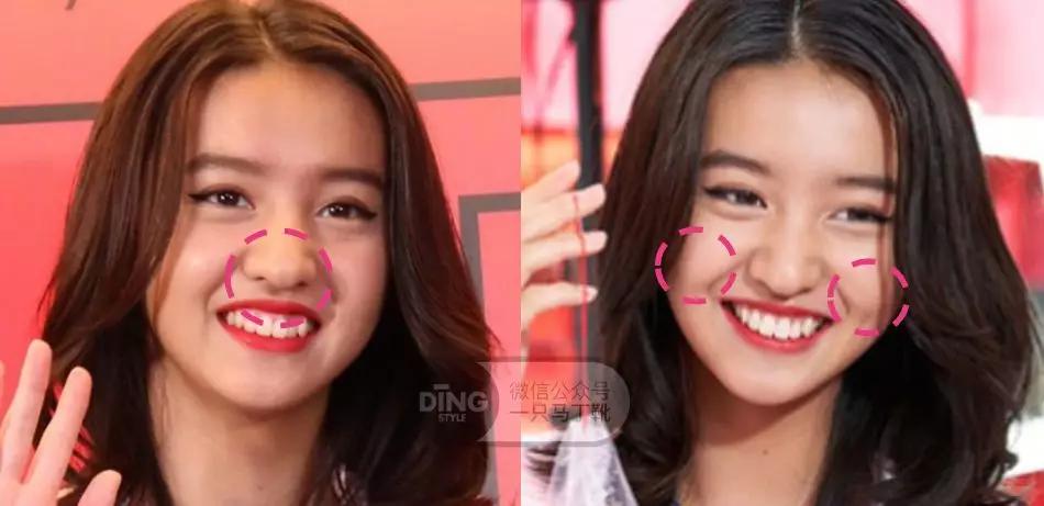 戴牙套凸嘴怎么化妆,凸嘴整牙削骨吗