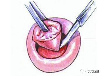 中医可以治宫颈癌前病变,宫颈癌术前疑难病例讨论范文