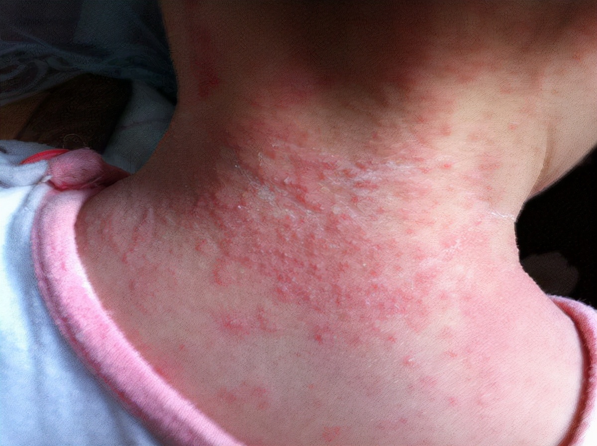 战痘的正确方法图解,五个“战痘”小妙招