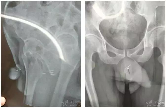 八岁女孩来大姨妈了疼痛难忍,八岁小女孩来姨妈