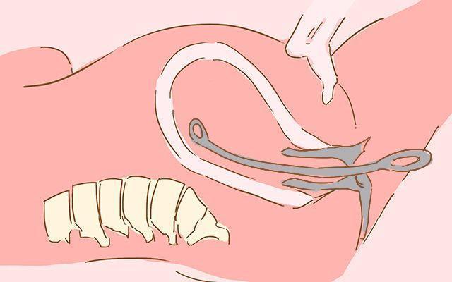 产科医生打胎女患者的结局,如何判断流产后胎儿是否彻底流产