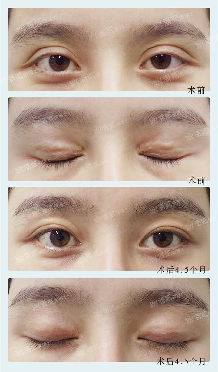 双眼皮整形的真实经历,为什么做双眼皮医生术前不沟通