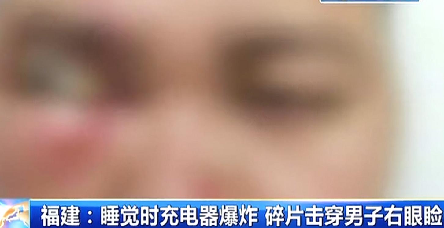 小伙充电器爆炸致眼睛失明,男子半夜睡觉充电器爆炸