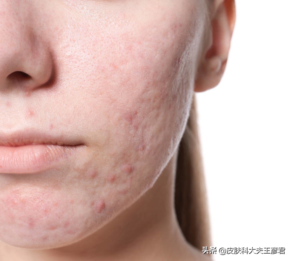 脸上不长痘头上长痘是什么原因,脸上从来不长痘突然长痘怎么回事