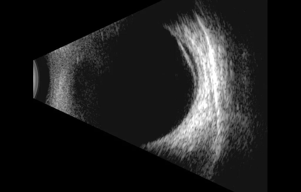 眼前突然出现黑影还很难受,眼前总有黑影飘是怎么了