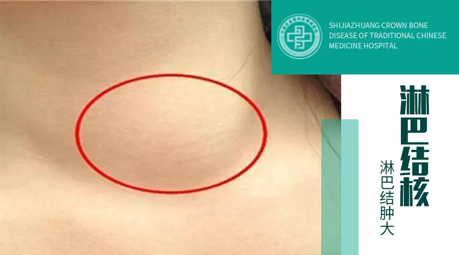 淋巴结核和淋巴瘤的超声鉴别,淋巴结核病理分析