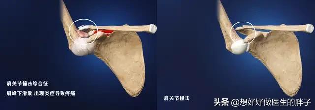 左侧肩膀疼痛预示十种病,哪些病可引起肩膀痛后背痛颈椎痛