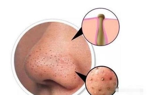 为啥粉刺挤了好得快,粉刺挤完长得更多怎么回事