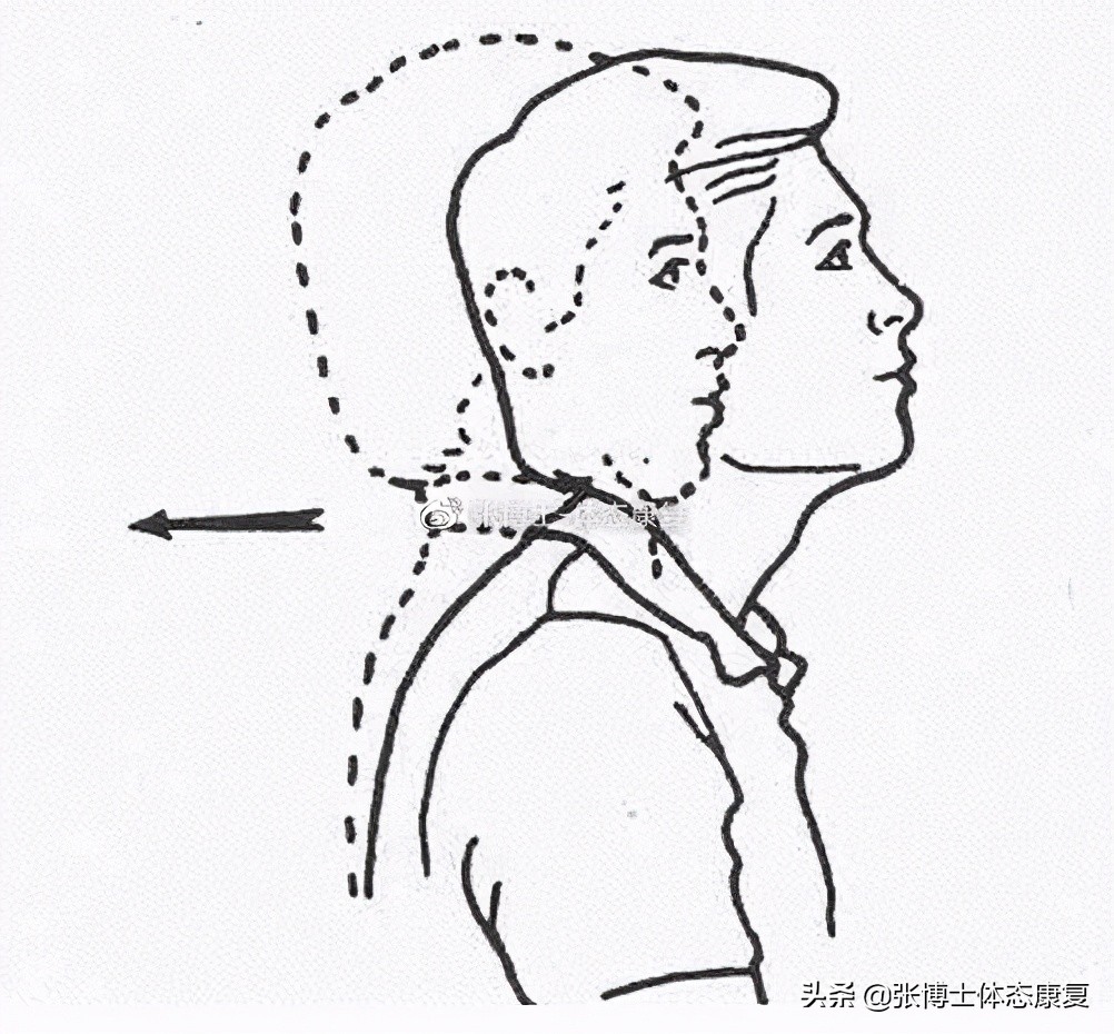 矫正体态消除富贵包,立竿见影消除富贵包绝技