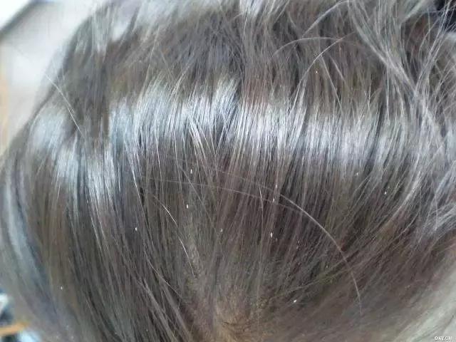 孩子头发上有小白屑是什么,孩子头发上好多白点点是虱子吗