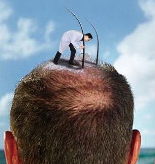 头顶全秃植发后的真实案例,90小伙脱发严重去植发