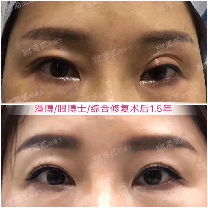 双眼皮失败的女孩,双眼皮失败做成了三眼皮好修复吗