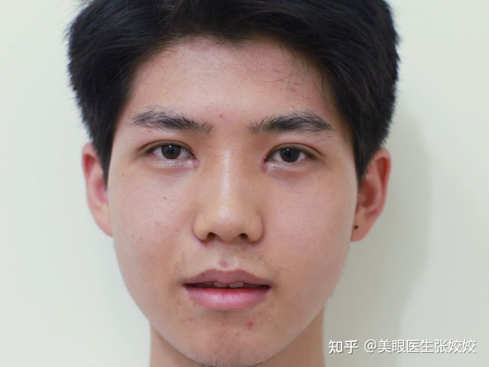 男生做双眼皮是全割还是埋线,男生肉眼泡双眼皮手术