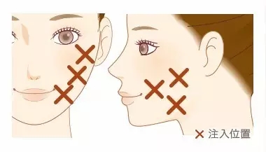 瘦脸针科普,科普打瘦脸针脸会凹陷变松吗