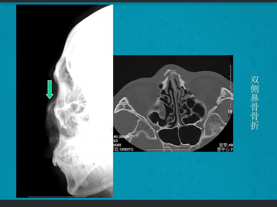 鼻骨骨折复位全过程,诊断证明鼻骨骨折问号是什么意思
