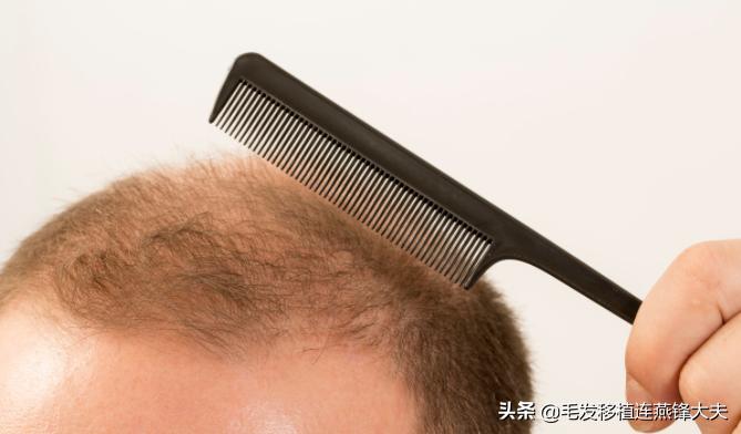 脱发2年,脱发一年了头发明显减少