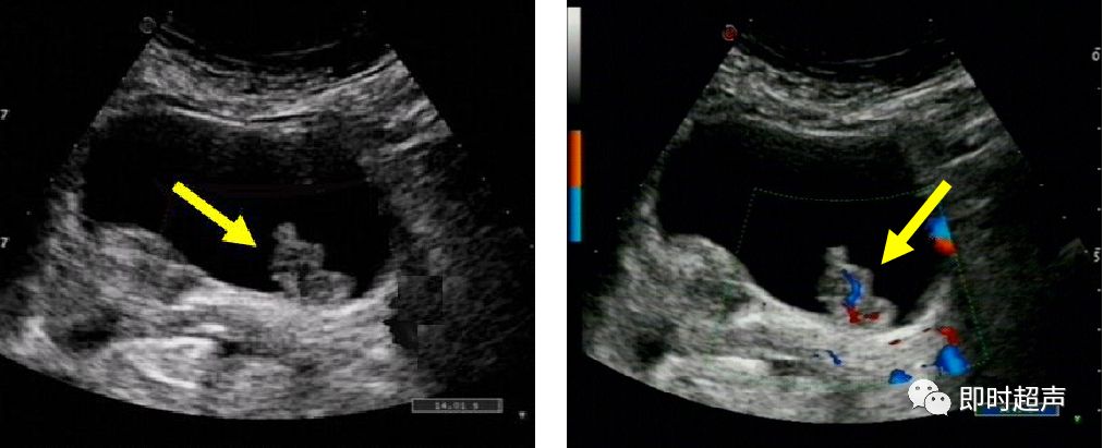 膀胱超声图解大全,膀胱超声解剖及常见病变超声表现