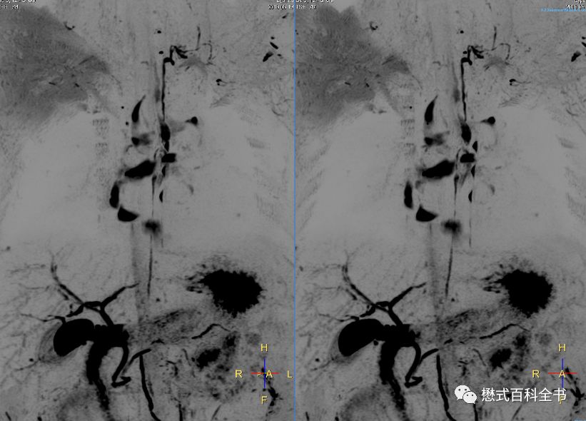 开展mrcp技术,mrcp检查操作流程